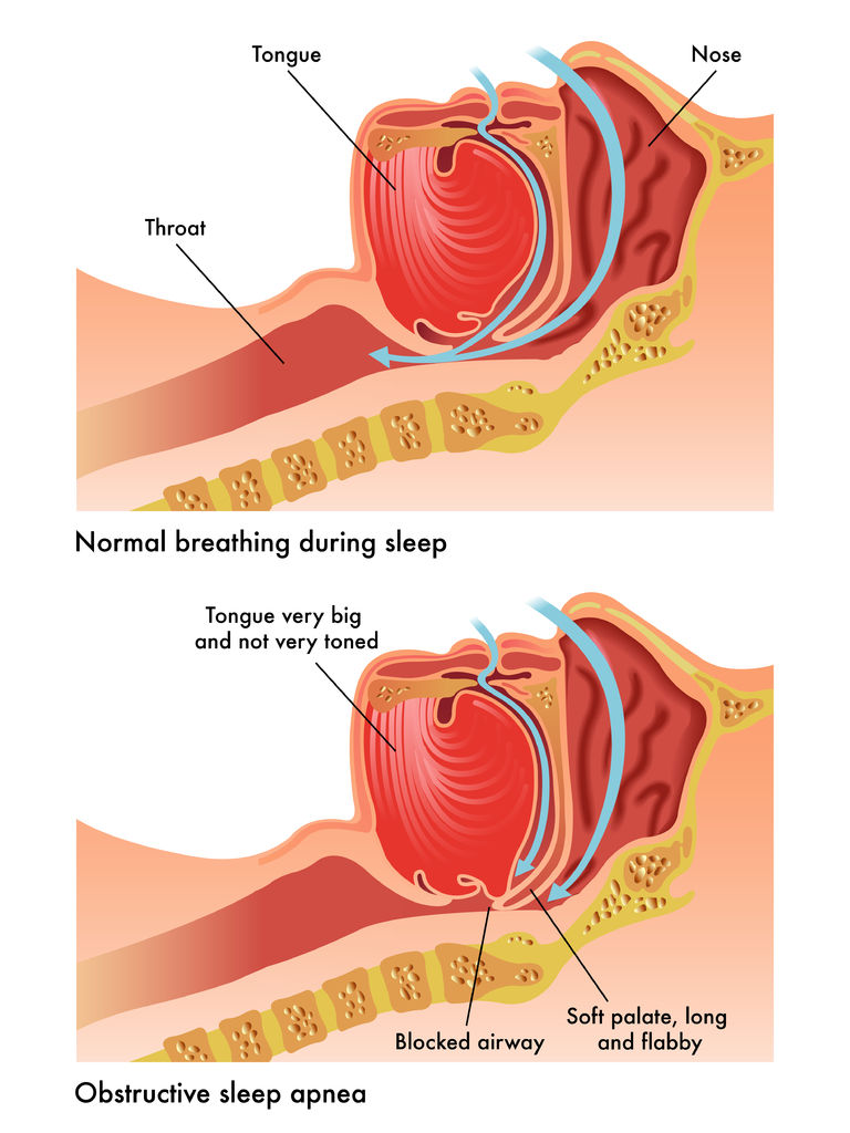 40700073 - obstructive sleep apnea