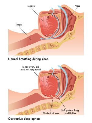 40700073 - obstructive sleep apnea