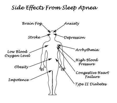 31164387 - sife effects from sleep apnea
